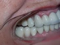 Patient's restored smile after treatment