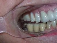 Patient's teeth before treatment