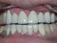 Patient's bright restored smile after treatment