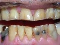 Patient's stained and damaged teeth before treatment
