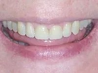 Patient's brightened smile after treatment