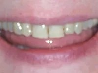 Patient's smile before treatment