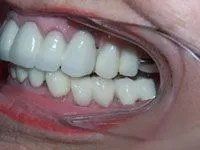 Patient's even white smile after treatment