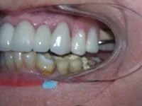 Patient's uneven teeth before treatment